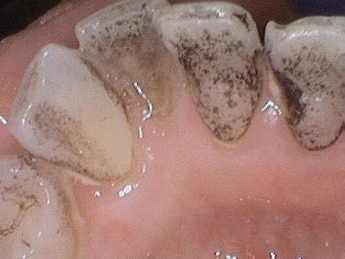 Severe tooth staining and calculus buildup on upper front teeth.