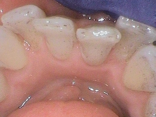 Heavy plaque and discoloration on lower anterior teeth, with gingival inflammation.