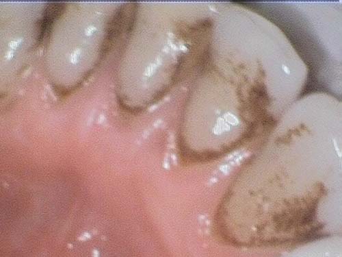 Dark brown tartar deposits along gumline of upper teeth.