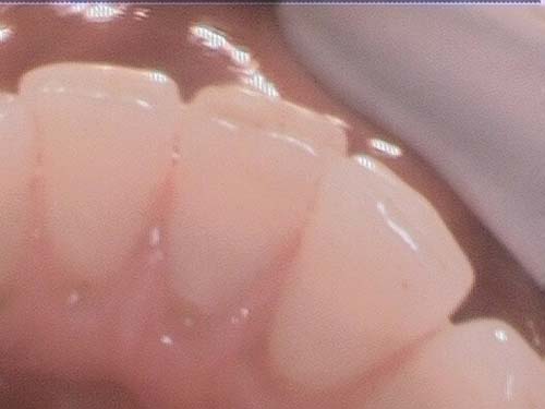 Clean, healthy-looking upper anterior teeth after scaling.