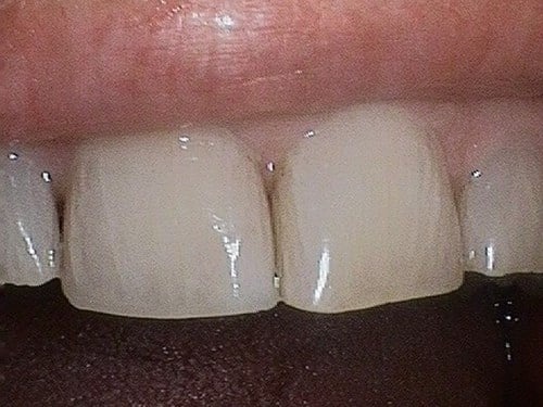 Upper anterior teeth with subtle discoloration and wear.