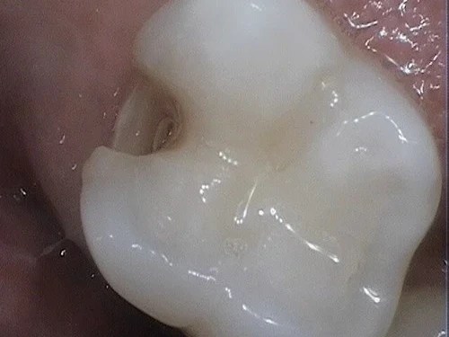 Molar with deep occlusal fissure and early caries.