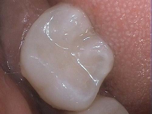 Restored molar with smooth composite filling.