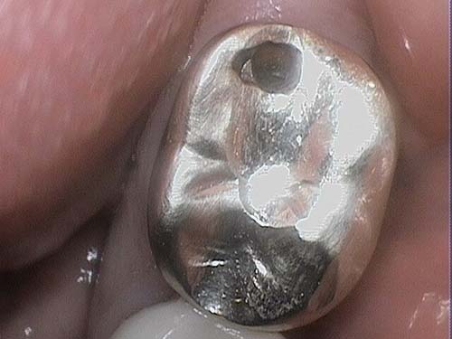 Amalgam filling with surface wear