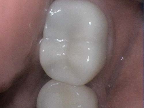 Healthy molar with intact occlusal anatomy and no decay.