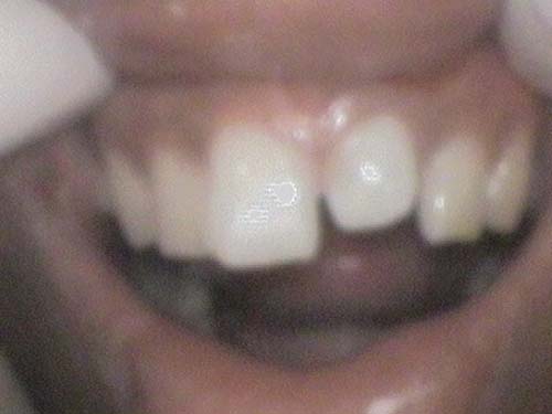 Upper front teeth with mild spacing and slight discoloration.