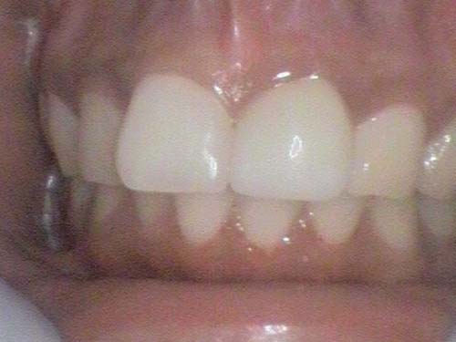 Upper anterior teeth showing slight crowding and enamel irregularities.