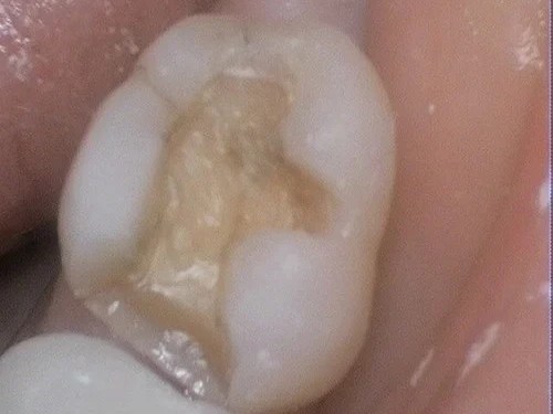 Tooth with cavity being treated