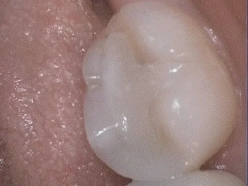 Restored molar with smooth, glossy white composite filling.