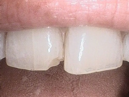 Upper incisors with chipped enamel on mesial edges.
