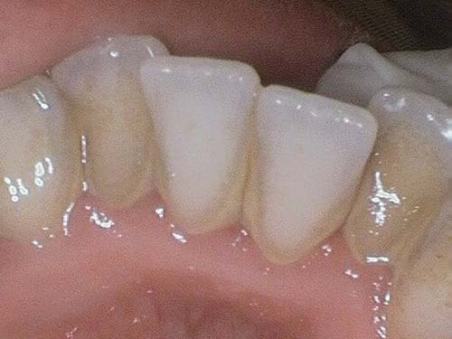 Upper anterior teeth with mild yellow staining near gums.