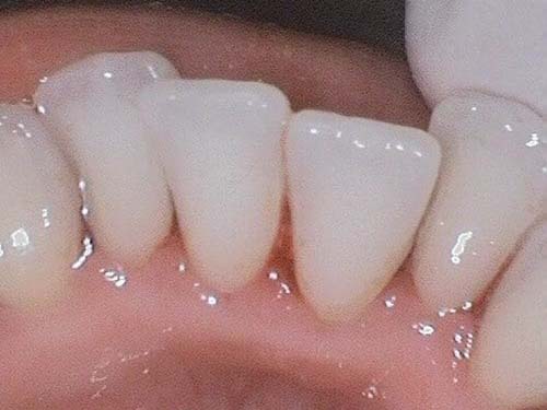Clean, well-aligned upper incisors with healthy gingiva.