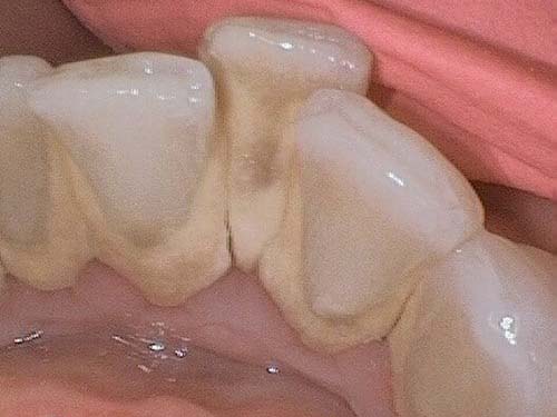 Teeth with visible plaque buildup and slight gingival redness.