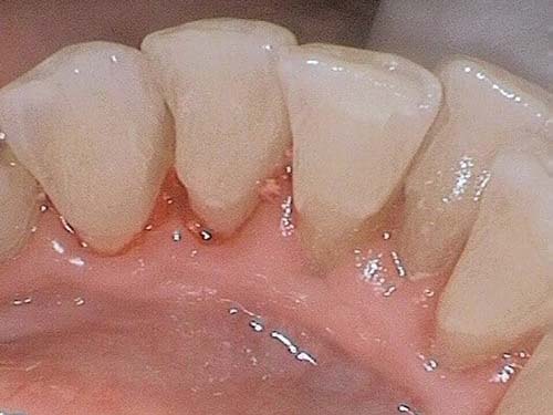Upper front teeth with mild gingival inflammation and slight plaque at gumline.