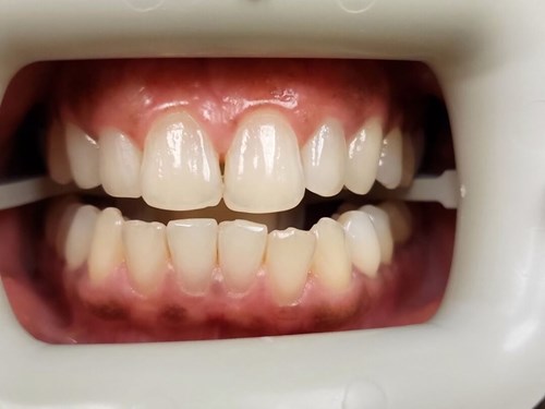 Full smile view showing mild crowding and diastema.