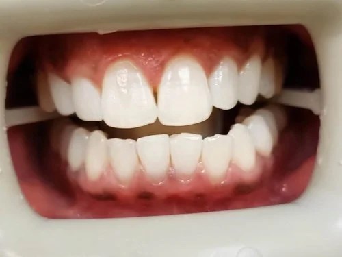 Full smile view showing mild crowding and diastema.